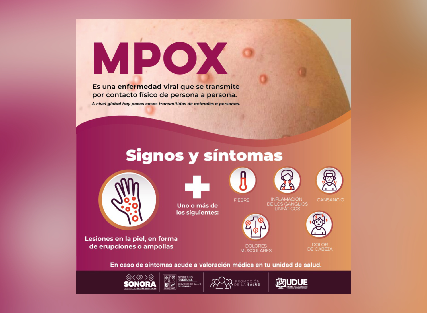 Salud Sonora atiende recomendaciones preventivas ante riesgos internacionales por Viruela del Mono (MPOX)